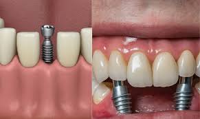 Exploring the Types of Dental Implants: A Comprehensive Guide