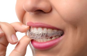 The Health Benefits of Orthodontic Braces