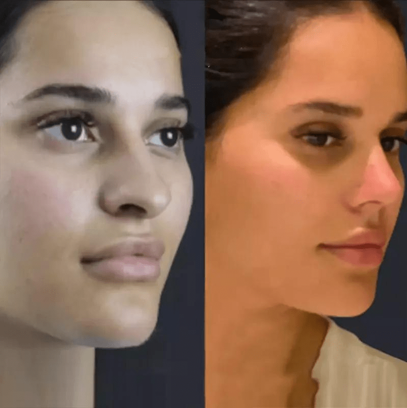 Preparing for Your Rhinoplasty Consultation in Dubai: What to Expect