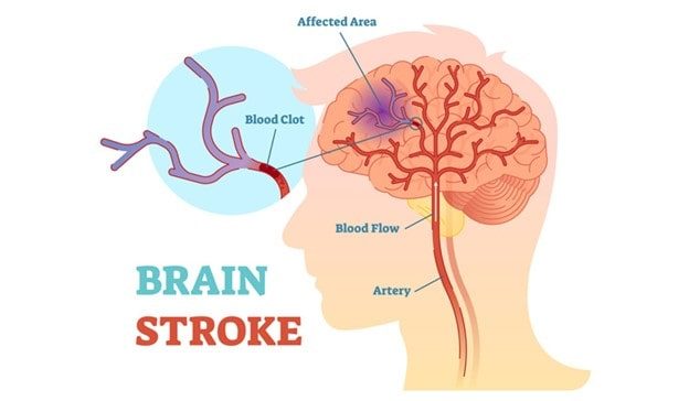 brain-stroke-min