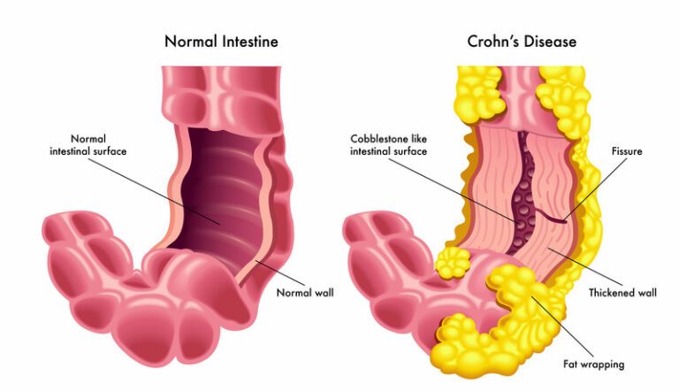 crohn-disease