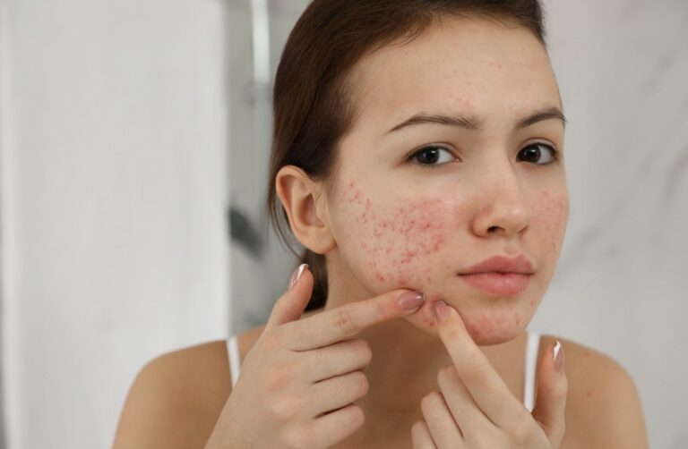 Skincare-Routine-for-Teenage-Girls-to-Prevent-Acne