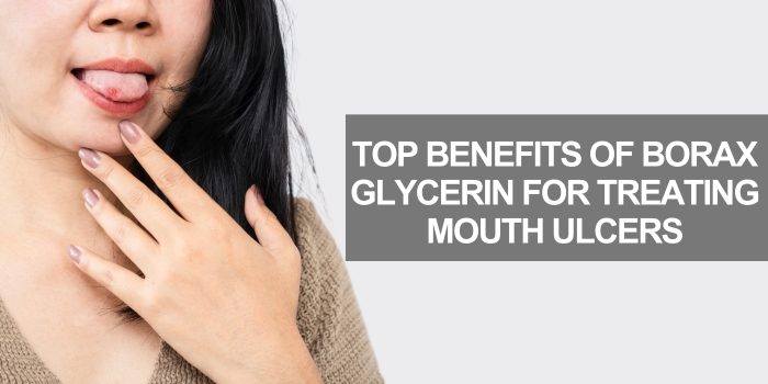 Top Benefits of Borax Glycerin for Treating Mouth Ulcers