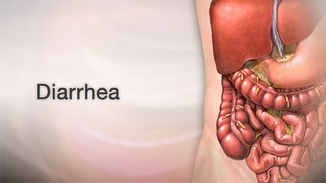 How is Diarrhea Caused? Insights from a Gastroenterologist