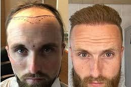 Hair-Transplant-Cost-in-Riyadhh