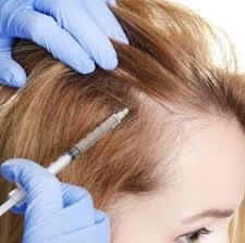 Why Choose PRP Hair Injections? Insights from Dubai Experts