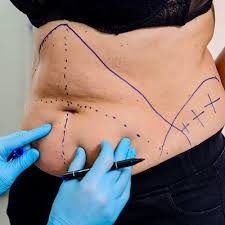 Liposuction-in-Riyadh12