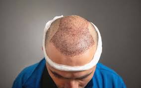 Achieve a Fuller Look with Riyadh’s Leading Hair Transplant Experts