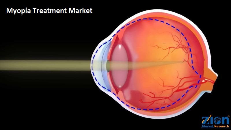 Myopia Treatment Market Size, Growth, Demand , Price and Forecast to 2032